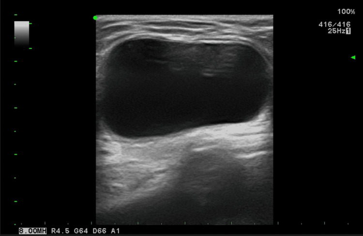 Grayscale ultrasound shows a large dark cystic region with brighter tissue deep to it, consistent with posterior acoustic enhancement. A static frame does not establish whether the collection communicates with the peritoneum.