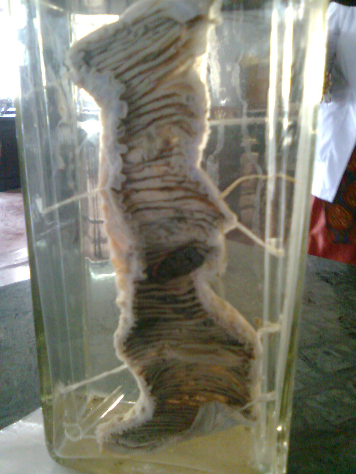 Opened resected colon containing a bulky irregular carcinoma that narrows the lumen.