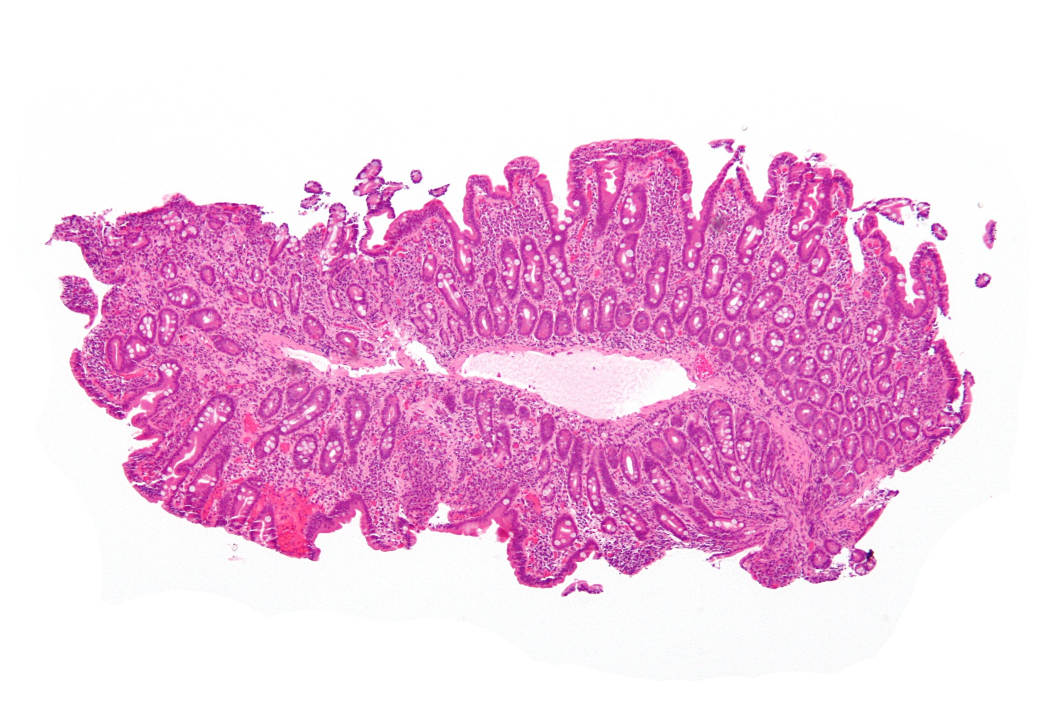 Low-magnification H and E small-bowel micrograph with shortened surface projections and gland-rich mucosa beneath them.