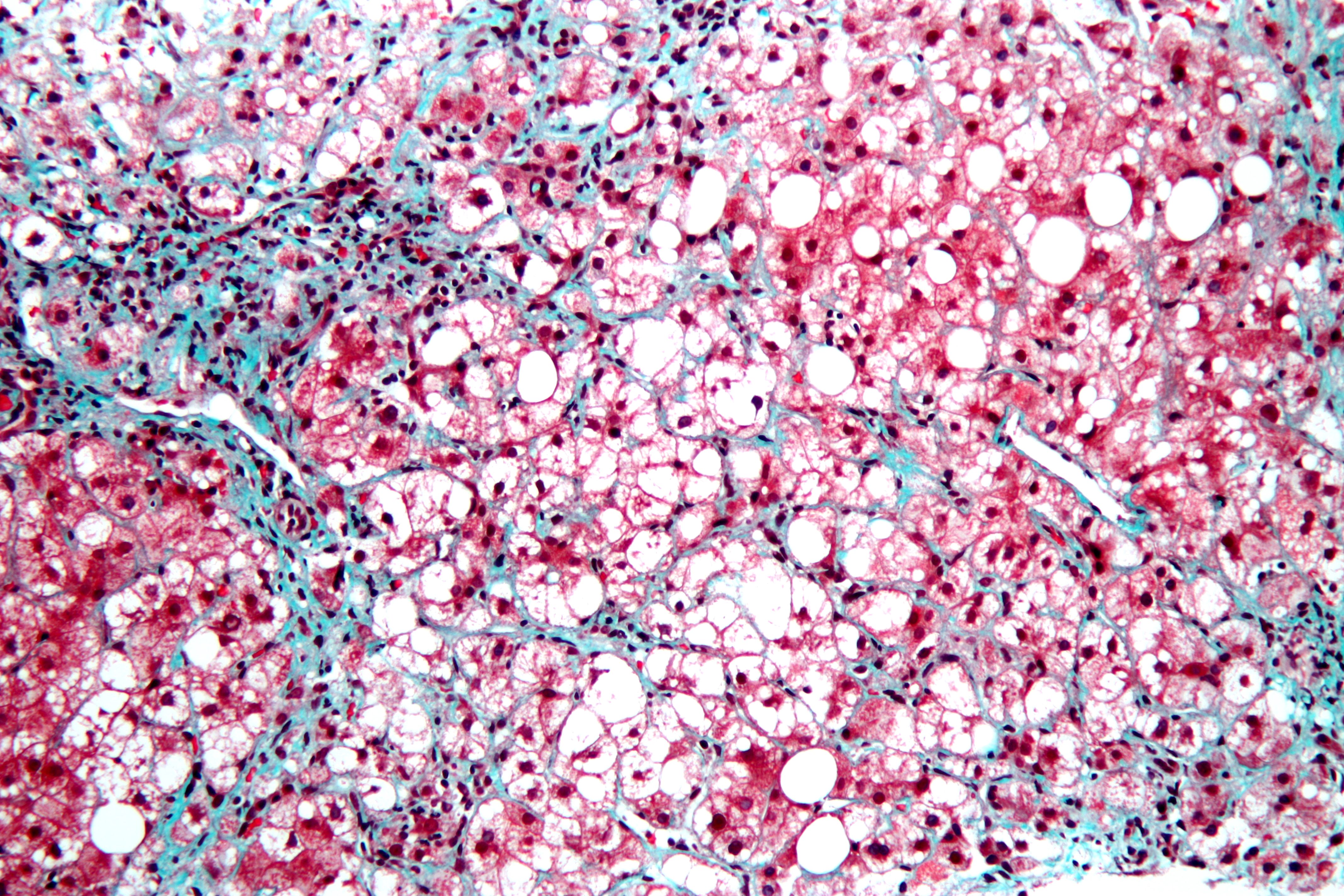 Trichrome-stained liver tissue has clear lipid spaces, pink hepatocyte cytoplasm, dark inflammatory nuclei, and blue-green collagen between cells.