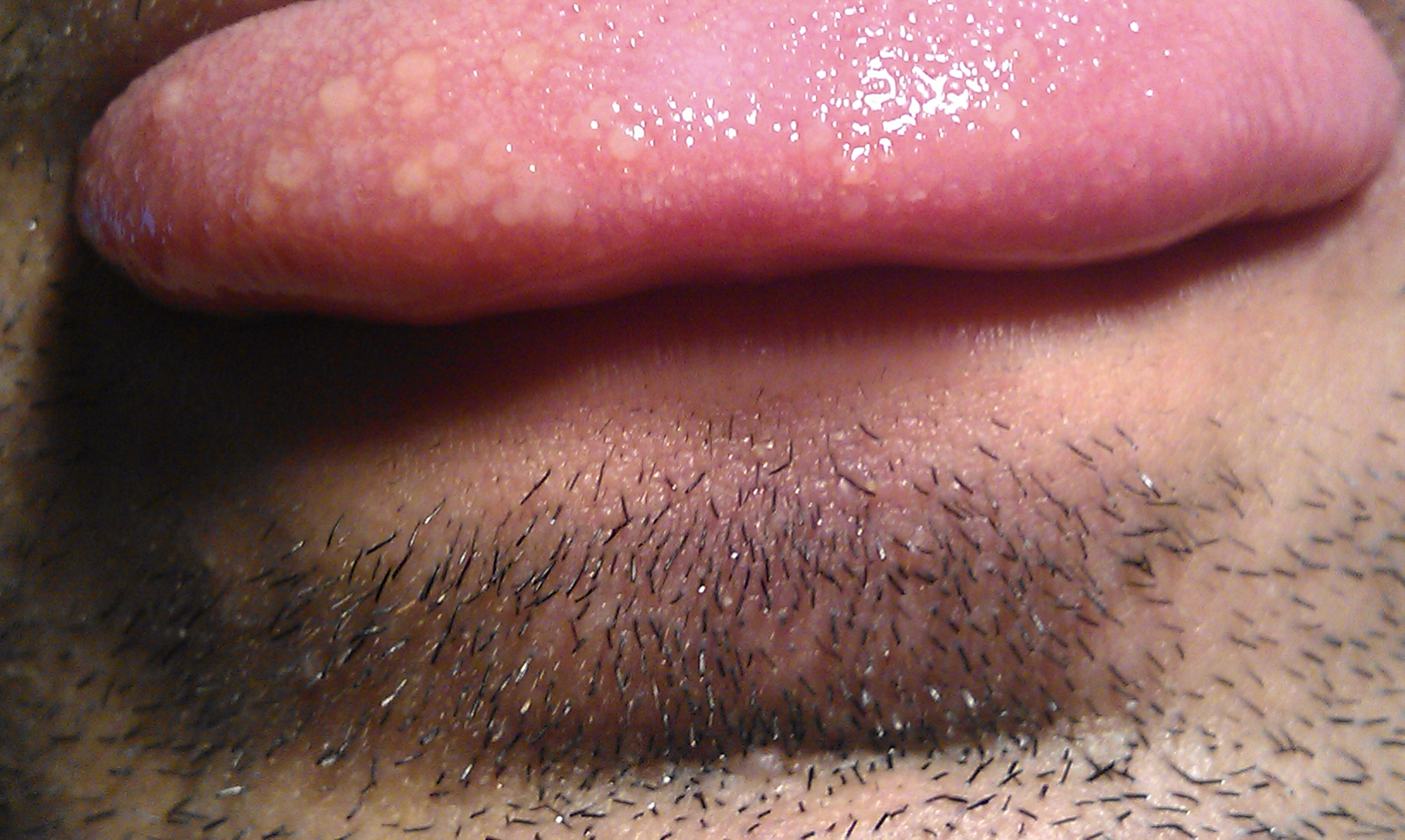 Close clinical view of a small pale-centered ulcer with an erythematous rim on the side of an extended tongue.