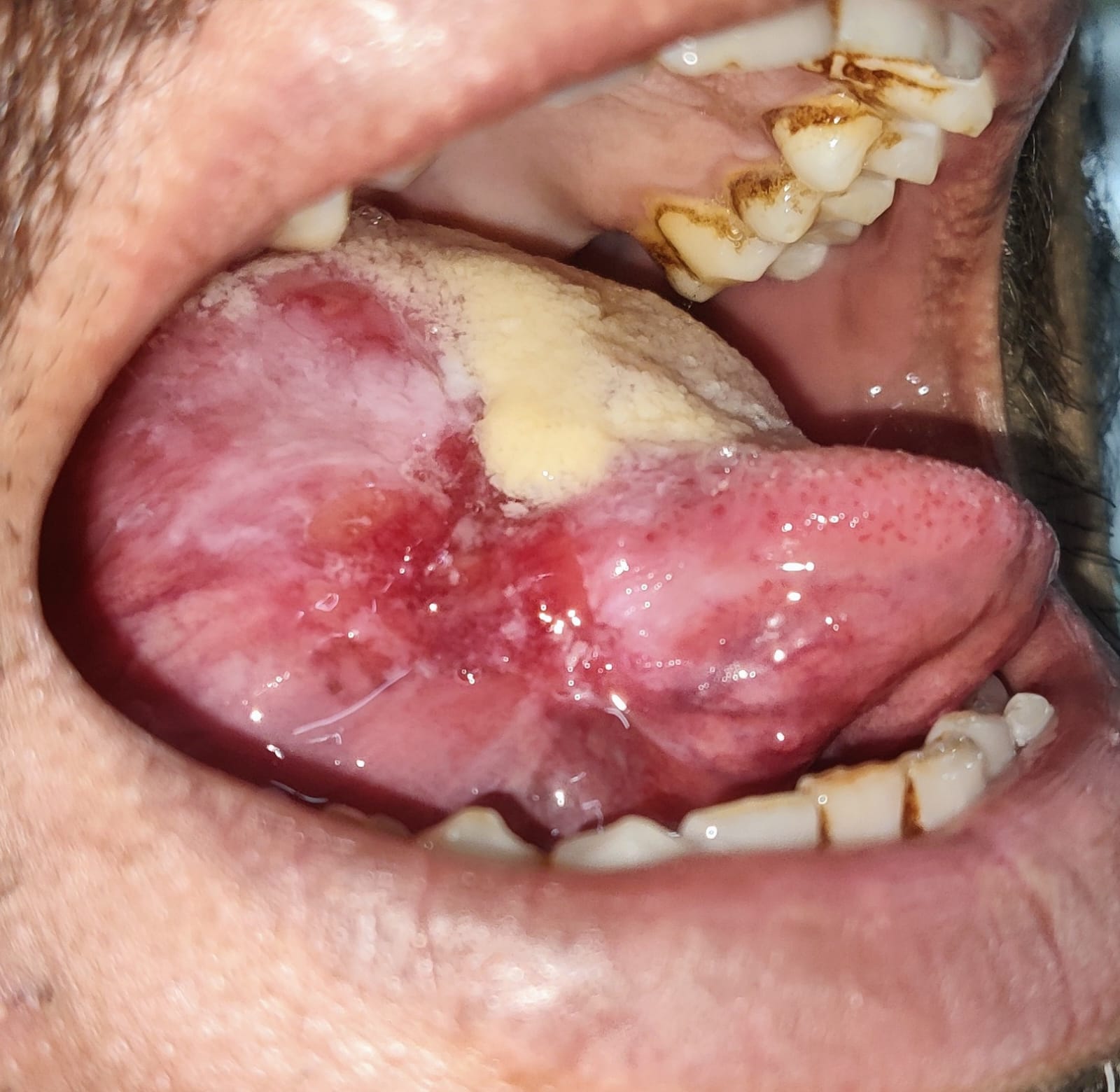 Clinical photograph showing a broad irregular red-and-white ulcerated region of the lateral tongue.