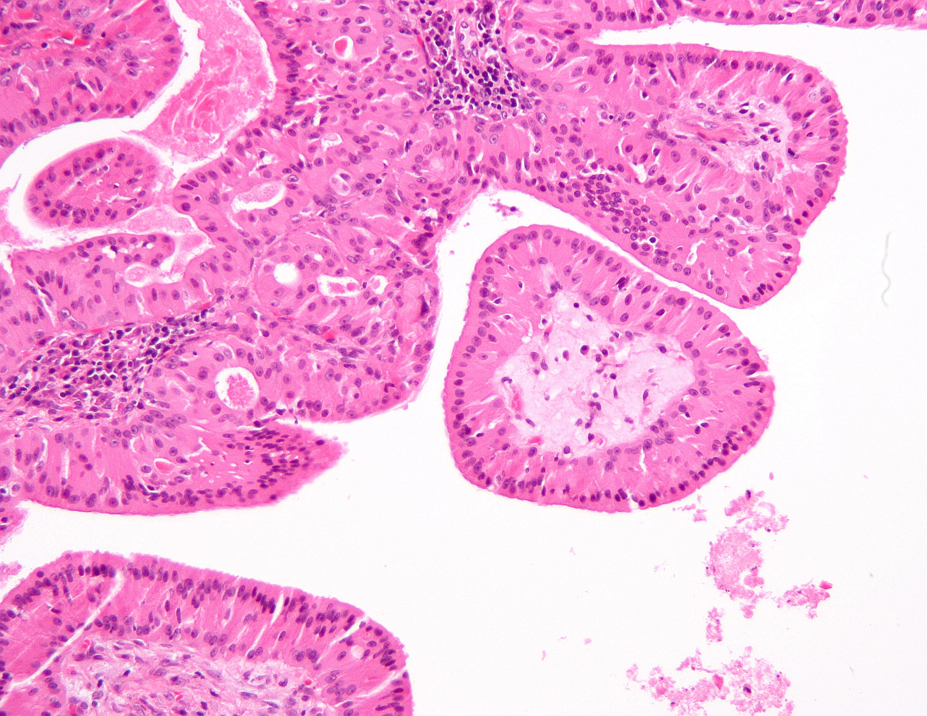 Histology micrograph of papillary projections with pink oncocytic epithelial lining and densely packed small lymphoid cells in their supporting tissue.