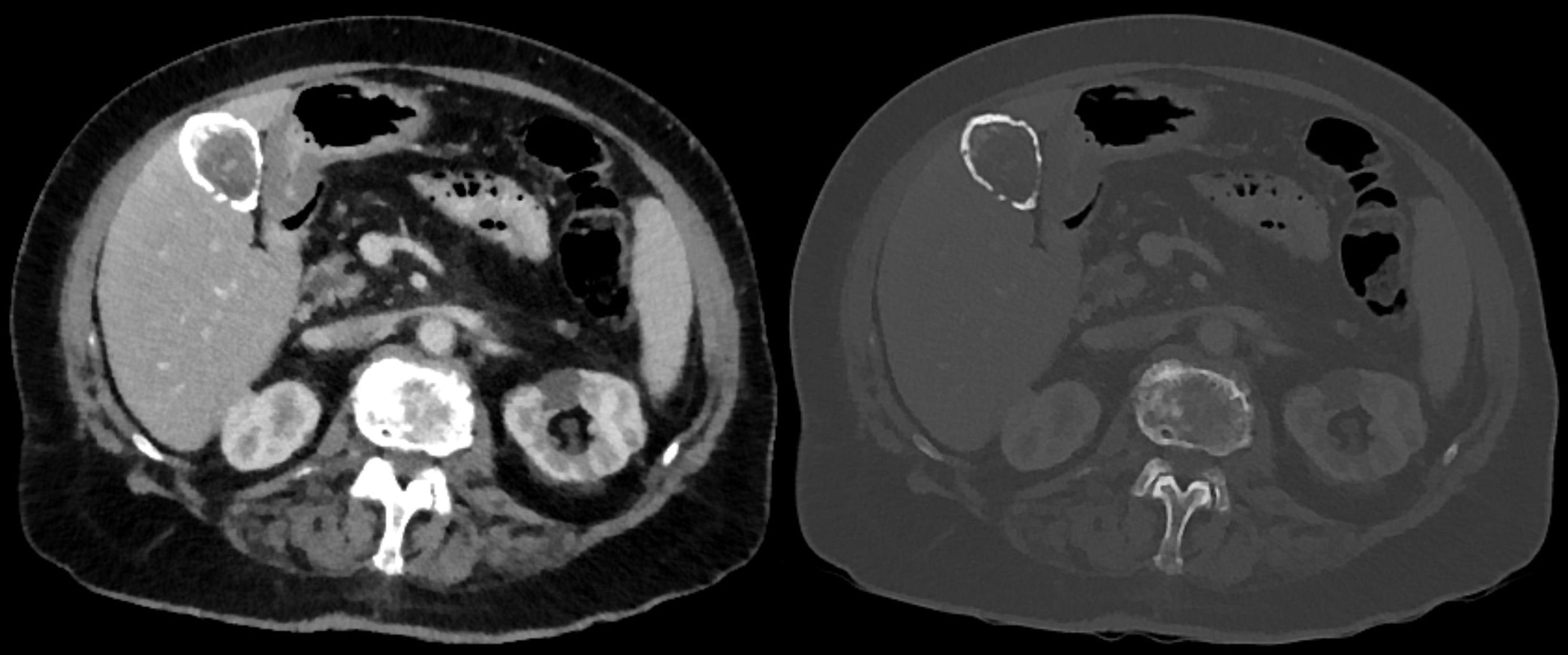 Two views of the same axial abdominal CT level. A dense oval outline beside the liver marks the gallbladder wall. The soft-tissue window is on the left and the bone window is on the right.