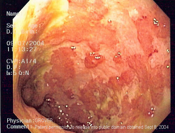 Endoscopic view of irregular red colonic mucosa with broad pale ulcerated areas and an uneven surface. The image does not display the entire distribution of disease.