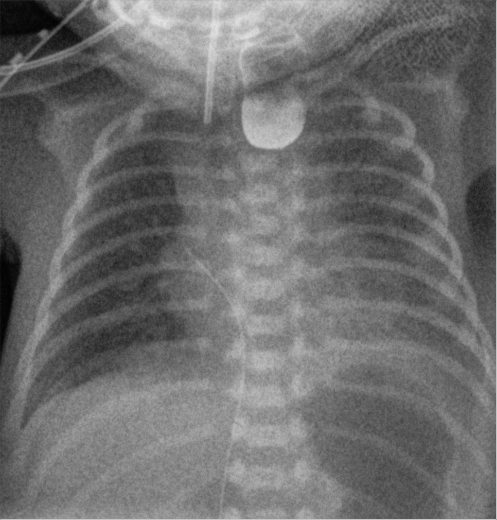 Frontal neonatal chest radiograph with contrast collected in a rounded blind upper esophageal pouch and a dark gas-filled stomach below the left hemidiaphragm. The fistula itself is not directly outlined.