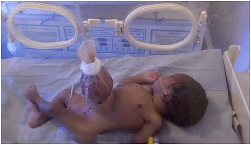 Clinical photograph of a neonate in an incubator with a transparent manufactured pouch suspended above the abdominal wall. The publication identifies this as a silo used after birth for gastroschisis; the original cord attachment and bowel viability cannot be established from this photograph.