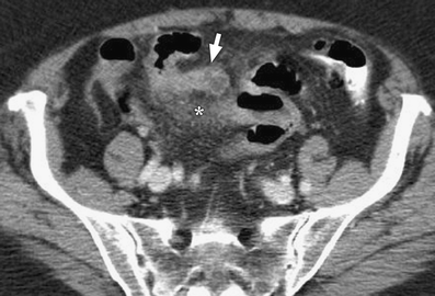 Axial abdominal CT shows a bowel outpouching at the original white arrow with adjacent fat stranding marked by the original asterisk.