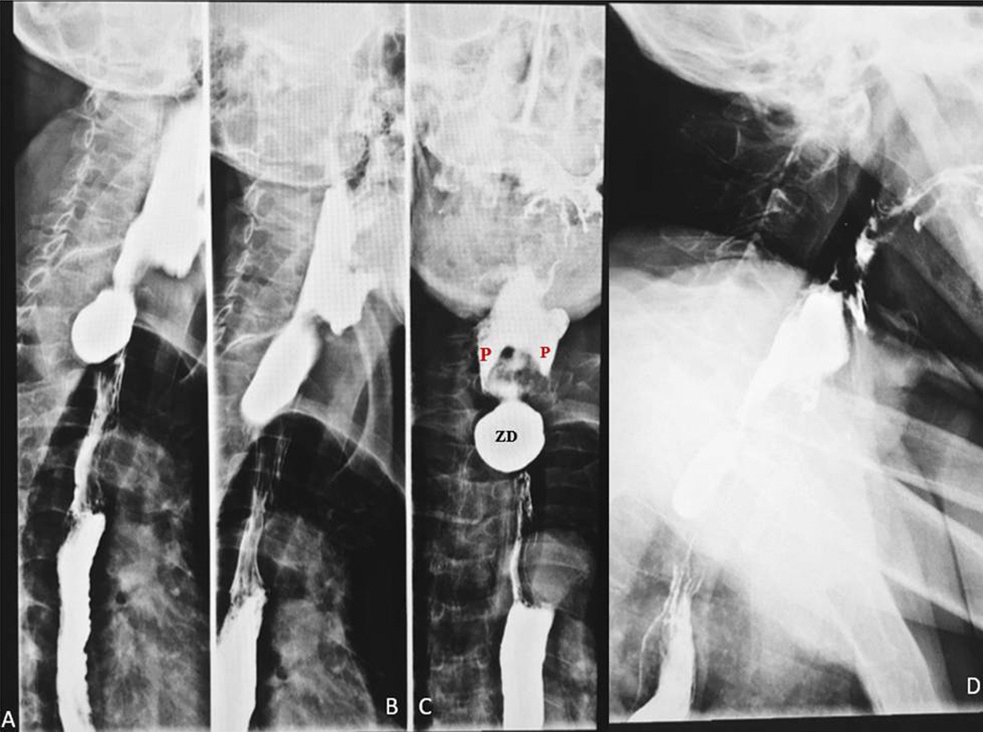 Four original esophagram panels show a posterior proximal contrast-filled pouch and contrast passage into the distal esophagus.