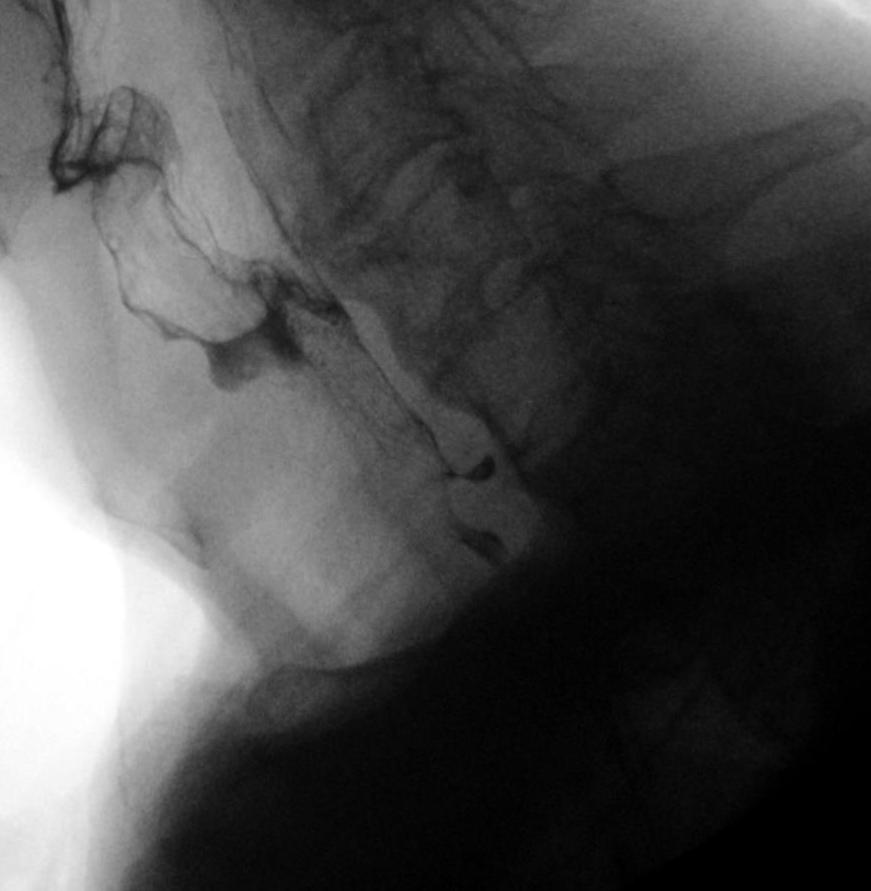 Lateral fluoroscopic image with the spine posteriorly. A small posterior contrast-filled projection appears near the lower end of the narrow cervical contrast column.