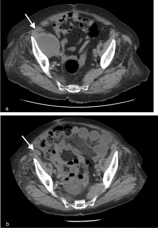 Two axial CT images. The upper panel A shows an enlarged right iliacus compartment on the left side of the displayed image, marked by a white arrow. The lower panel B shows its appearance one year later after resolution.