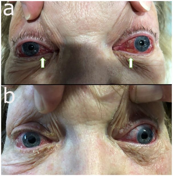 Original two-panel eye photograph from a bilateral carotid-cavernous fistula case. The upper panel has marked conjunctival swelling and congestion with the authors' arrows. The lower panel shows the appearance reported one day after embolization, with less visible swelling.