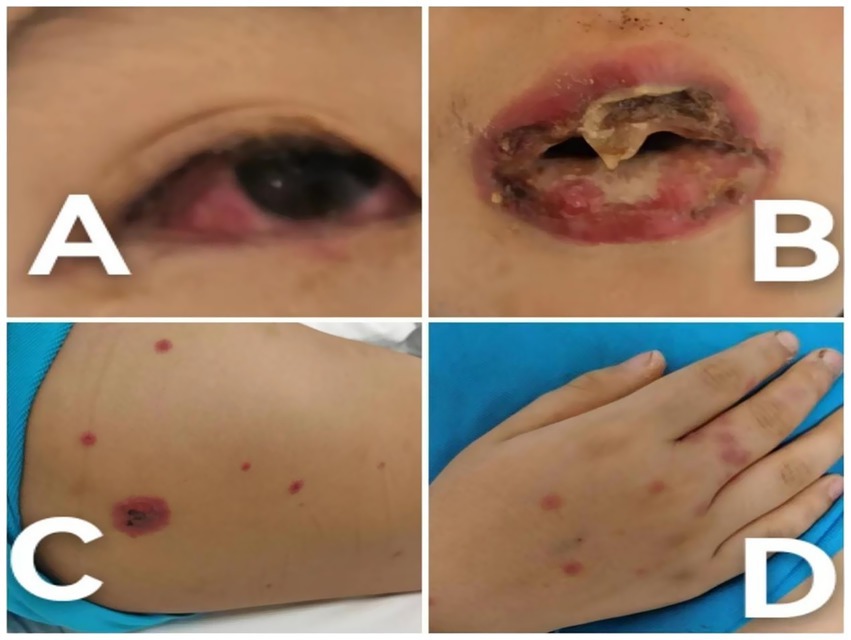 A four-panel clinical photograph shows conjunctival redness, crusted eroded lips and scattered round skin lesions, including lesions on the back of a hand.