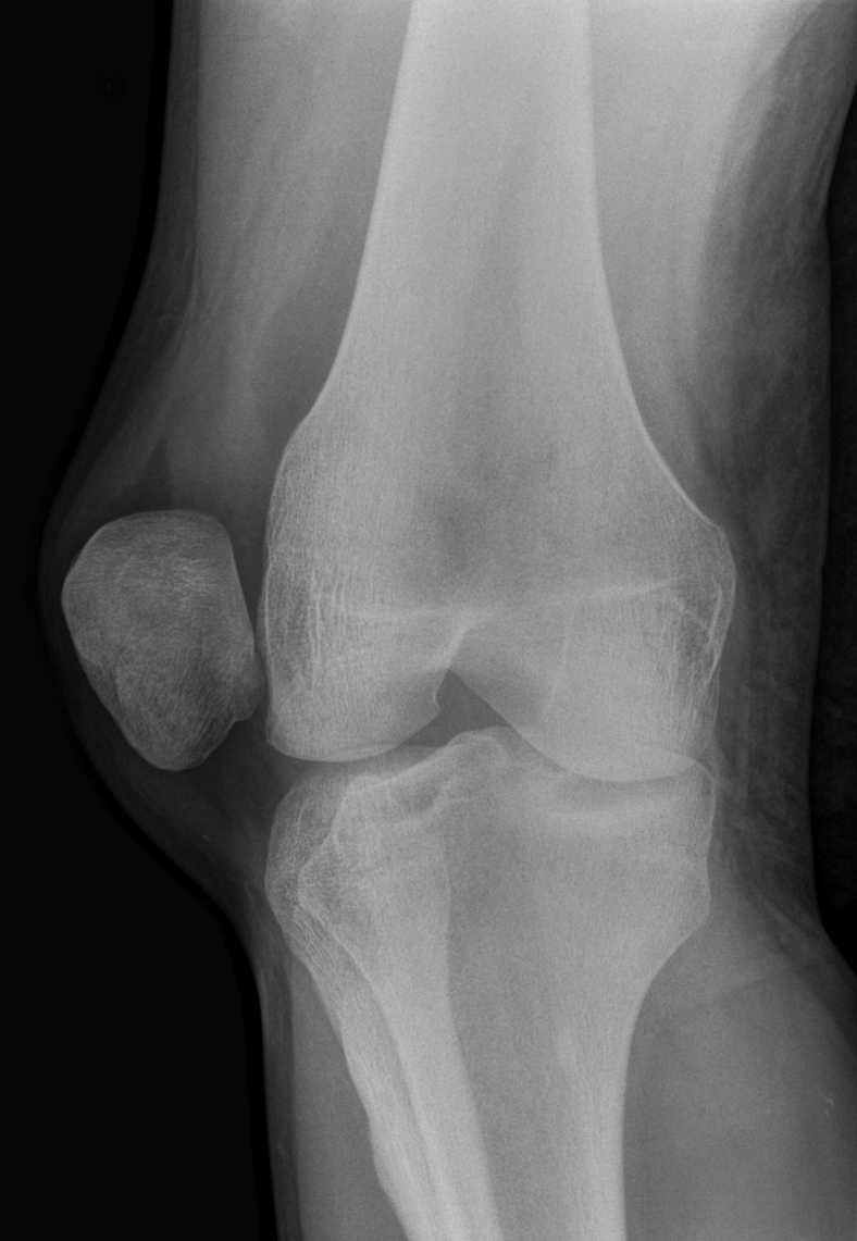 An anteroposterior right knee radiograph shows the patella displaced lateral to the distal femur, on the same side as the fibula.