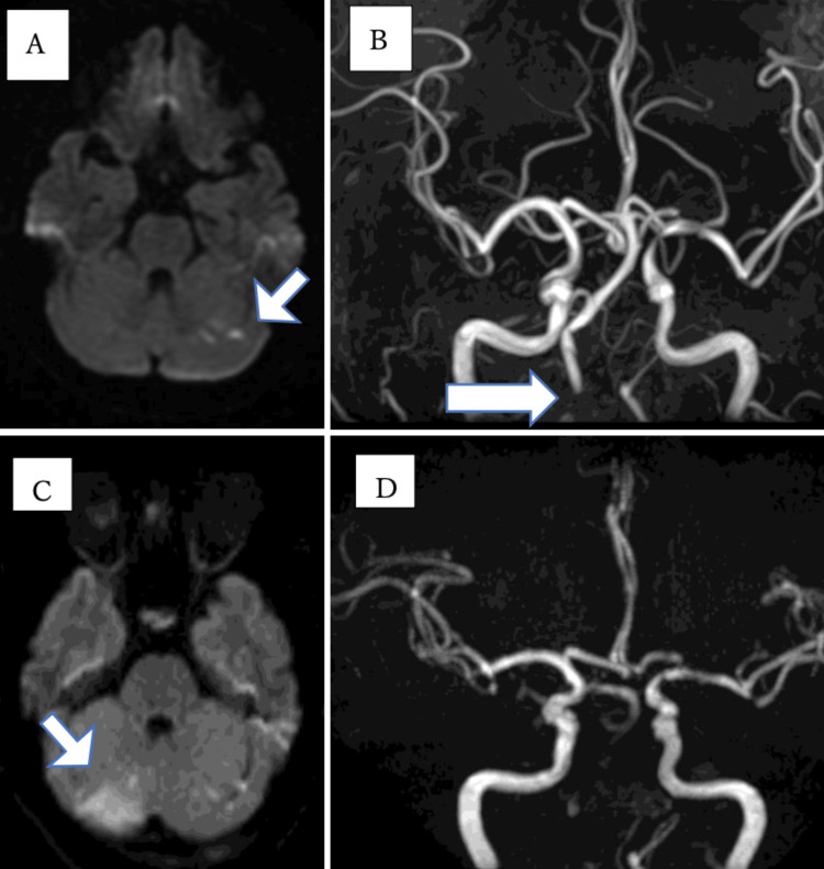 Original four-panel clinical MRI and MRA. A shows focal cerebellar diffusion abnormality; C shows more extensive cerebellar injury the next day. B shows right vertebral narrowing and D lacks right vertebral and basilar flow-related signal.