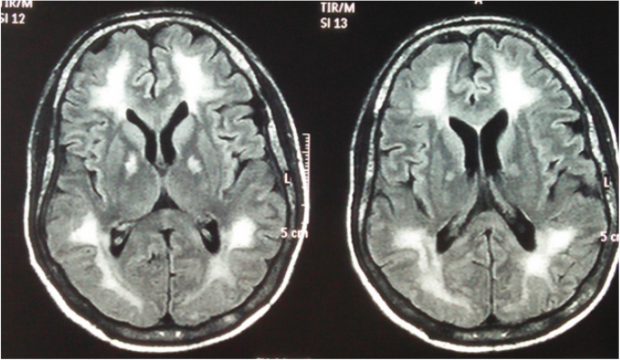 Two axial FLAIR images show bilateral confluent bright cerebral white matter in a published case of delayed neurologic deterioration after CO exposure.