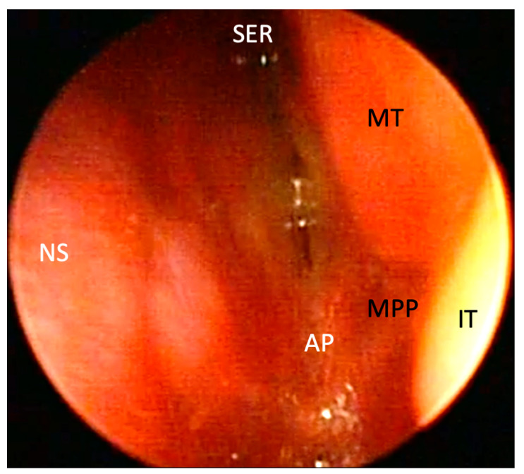 Published endoscopic view of the left nasal cavity in a neonate with choanal atresia. AP labels the atretic plate; NS labels the nasal septum. The outlet is occupied by tissue rather than an open posterior air passage.