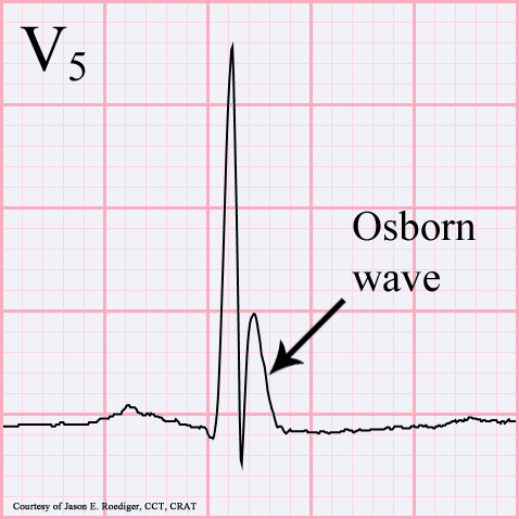 Clinical ECG excerpt in lead V5. A tall QRS is followed by a distinct positive J deflection; the original arrow and Osborn-wave annotation identify it. The source courtesy credit remains visible.