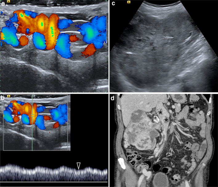 Four original publication panels: a, dilated right scrotal veins with color Doppler flow; b, spectral venous reflux at baseline with little change during Valsalva; c, a right renal mass; d, CT showing renal-vein and caval tumor extension, marked by the original curved arrow and asterisks.