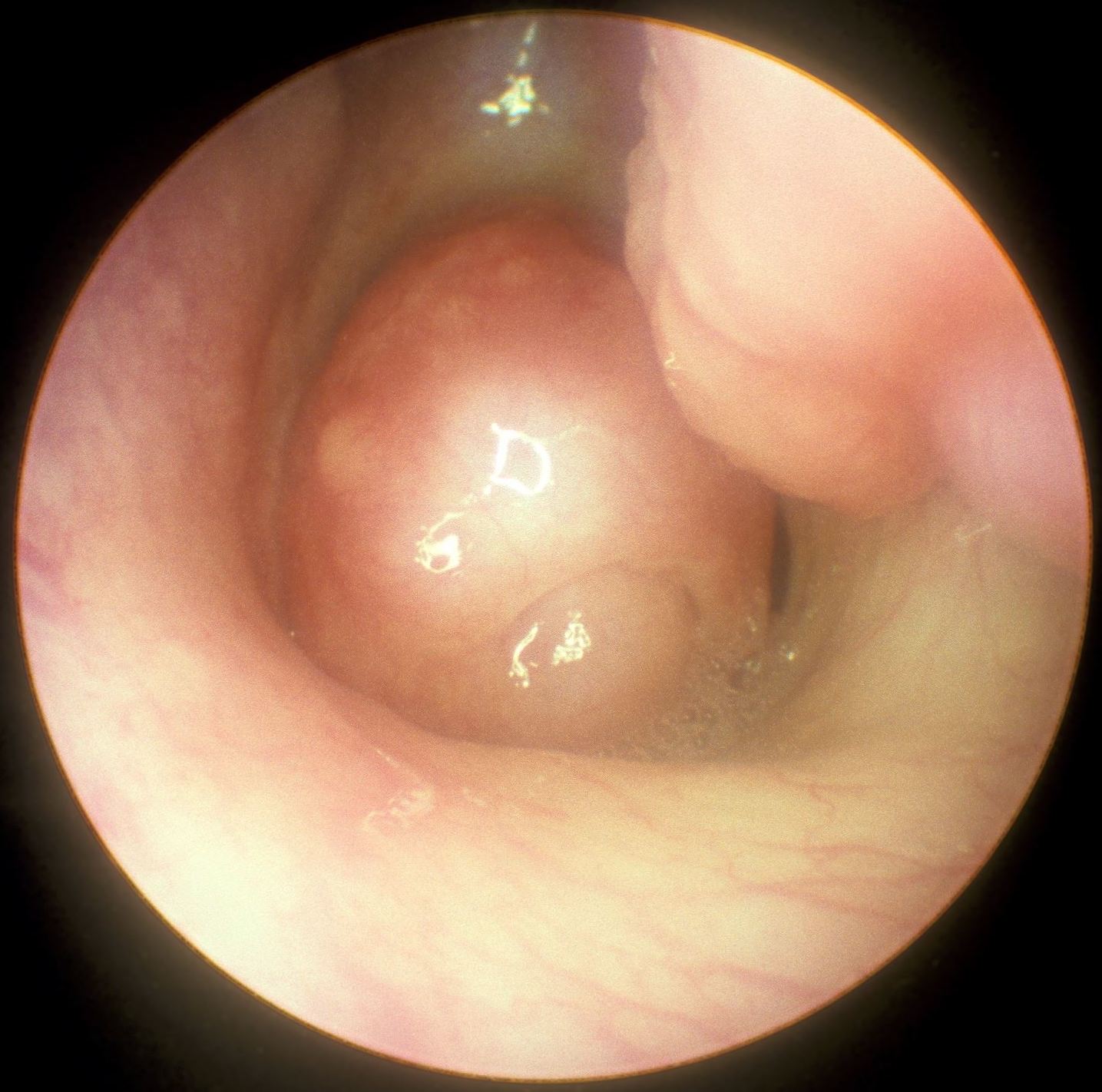 Endoscopic view with a smooth rounded central mass occupying much of the posterior nasal opening; adjacent mucosa and a turbinate remain visible.