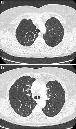 Published axial chest CT pair: source-circled region in panel a is hazy with visible internal structures; source-circled region in panel b contains a denser central component.