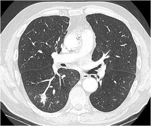 Axial lung-window CT shows a peripheral right lower-lobe nodule with irregular fine extensions into the surrounding aerated lung.