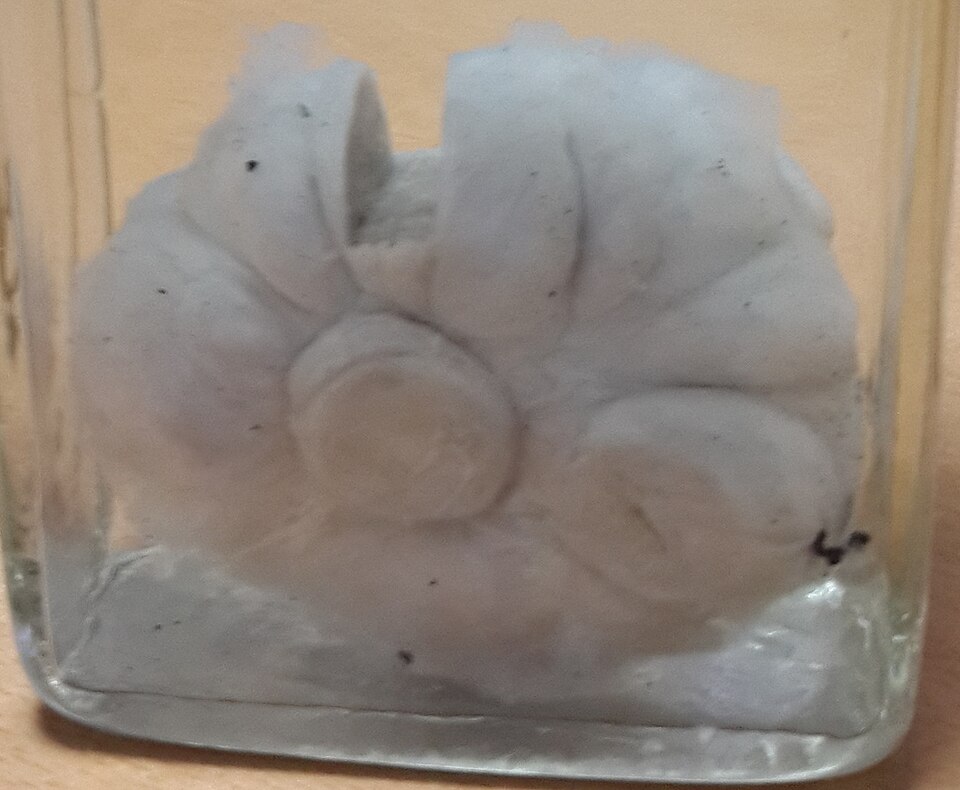 Gross specimen of a breast fibroadenoma: a well-circumscribed, rubbery, lobulated mass